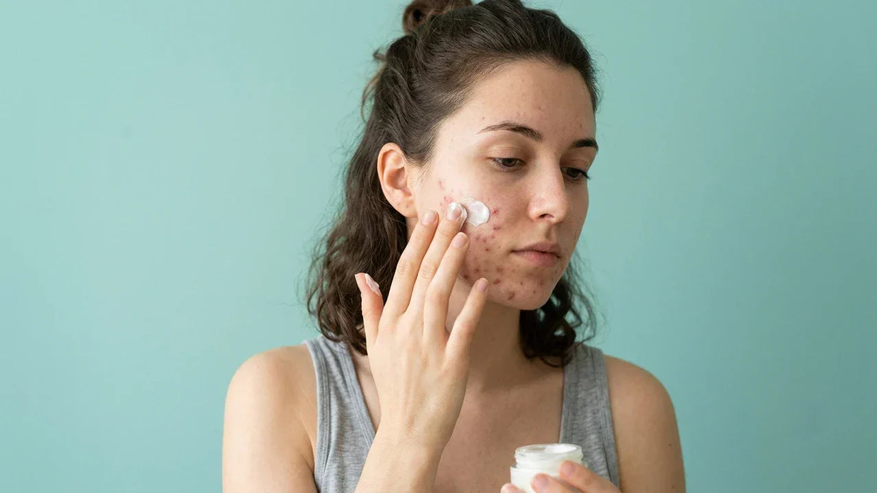 best sunscreen for acne prone skin 